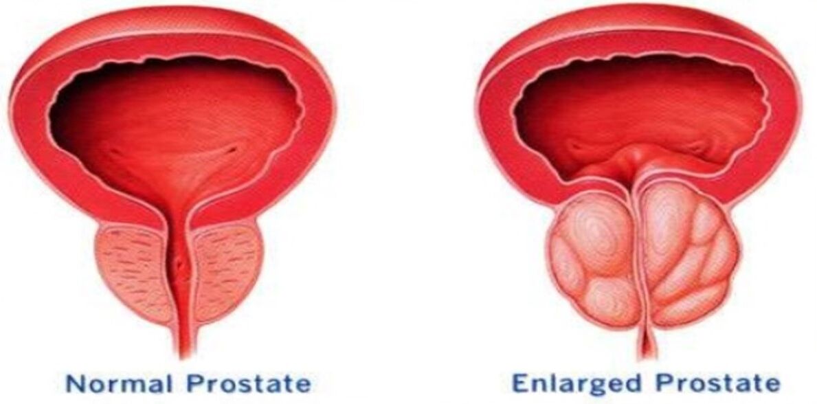 Normale Prostata, entzündete Prostata